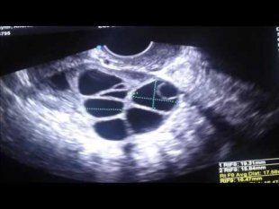 Vidéo d’une échographie d’ovaire stimulé